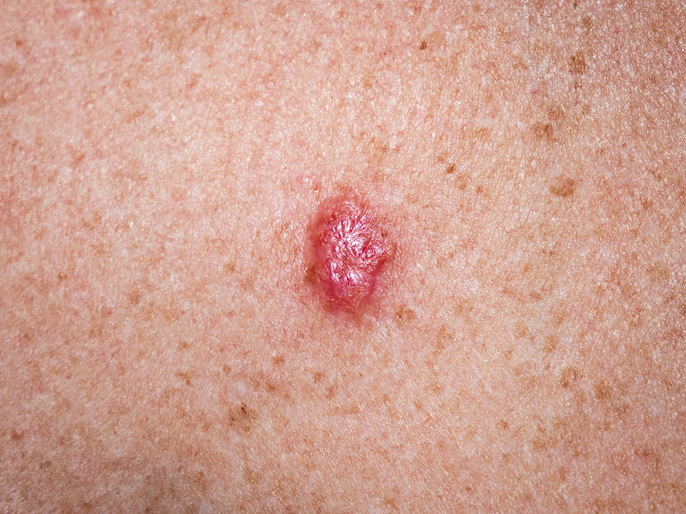Young female close up of chest prior to applying  medication to basal cell carcinoma.