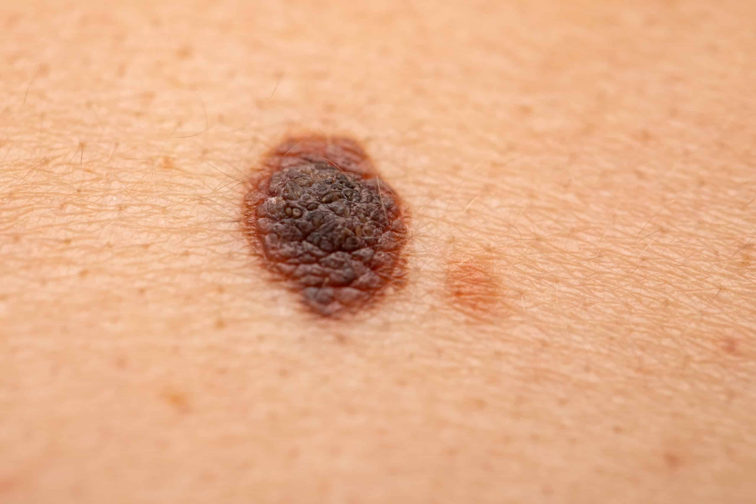 Dangerous nevus on skin melanoma